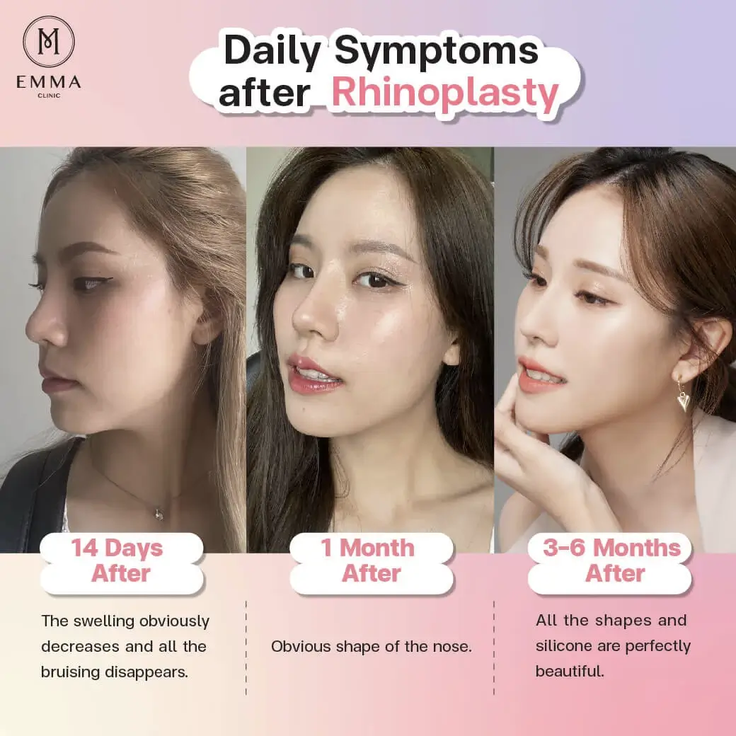 Daily symptoms after rhinopasty 14 days Nose Surgery EMMA CLINIC