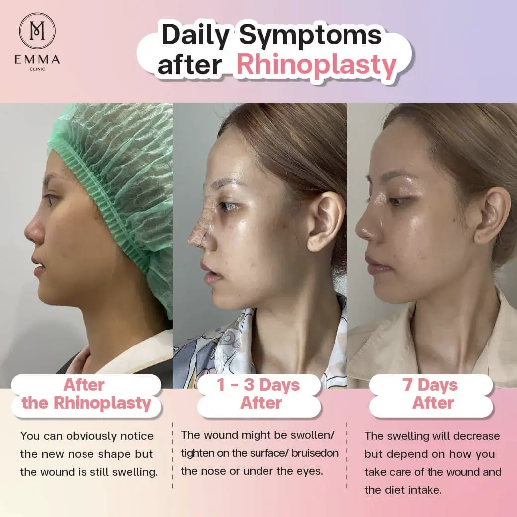 Daily symptoms after rhinoplasty Nose Surgery EMMA CLINIC