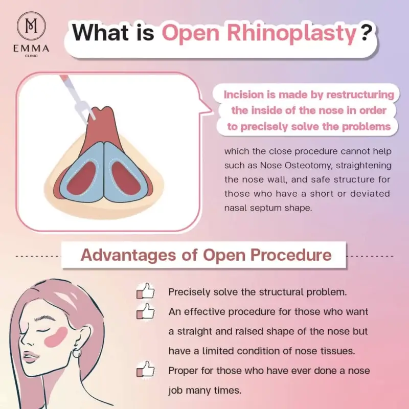 what is open rhinoplasty Nose Surgery EMMA CLINIC