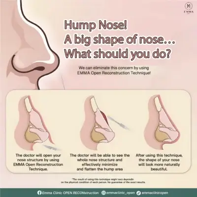 Artwork2ENG Open nose augmentation EMMA CLINIC