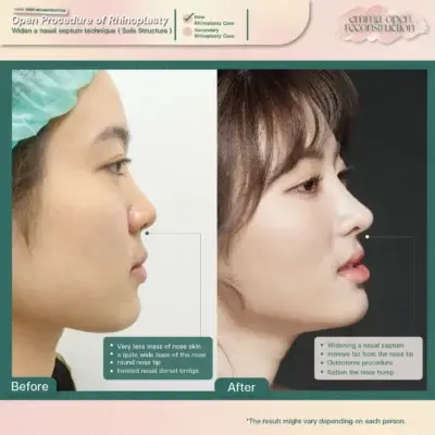 จันทร์ 1 Open nose augmentation EMMA CLINIC
