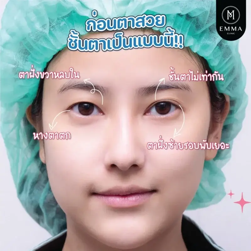 ทำตาสองชั้นเกาหลี รีวิวก่อนทำ double eyelid surgery EMMA CLINIC