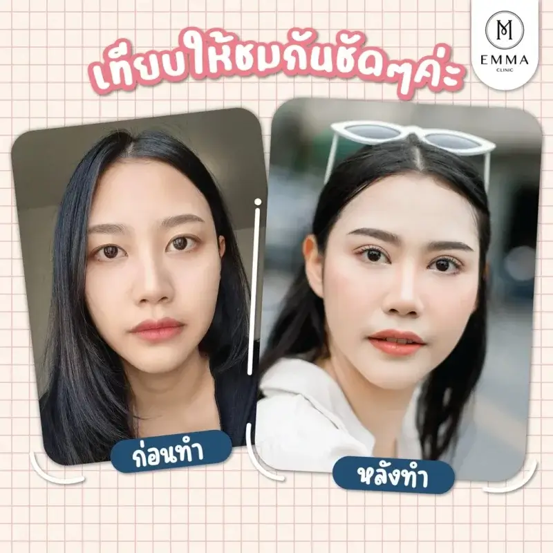 Before After เทียบทำตาสองชั้น Milli Eyes by Emma