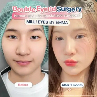Review Double Eyelid Surgery