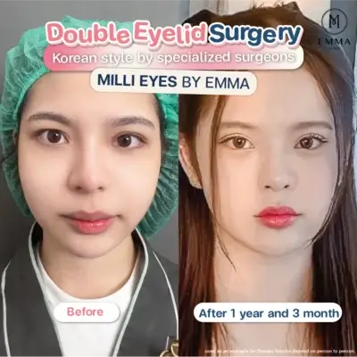 Review Double Eyelid Surgery