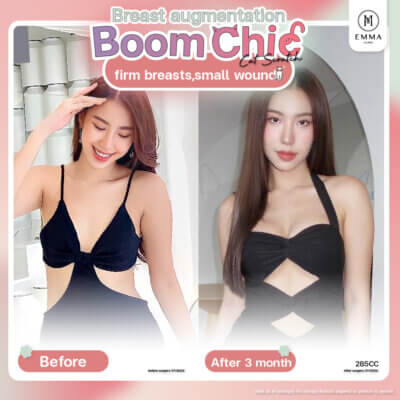 BoomChic Breast augmentation