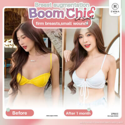 BoomChic Breast augmentation