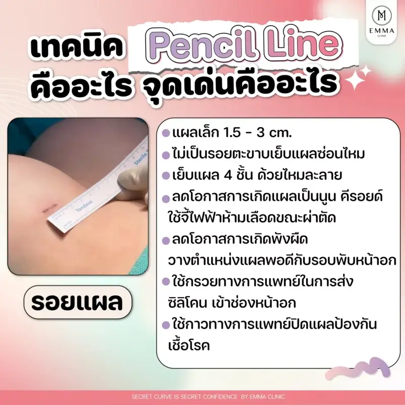 เทคนิค Pencil Line คืออะไร